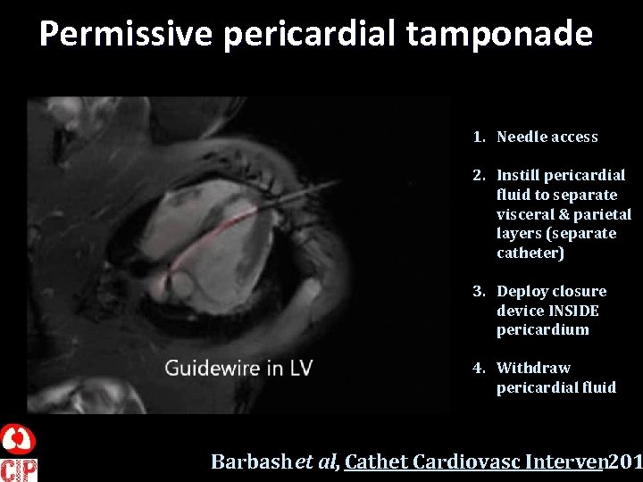 Permissive pericardial tamponade 1. Needle access 2. Instill pericardial fluid to separate visceral &