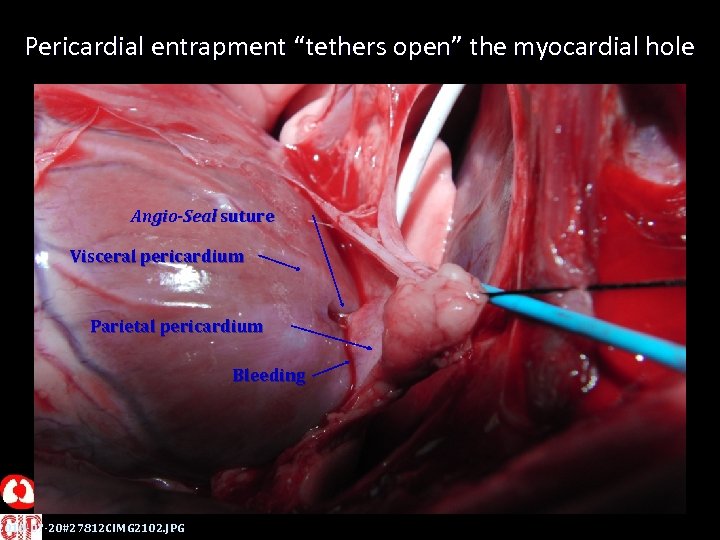 Pericardial entrapment “tethers open” the myocardial hole Angio-Seal suture Visceral pericardium Parietal pericardium 2010