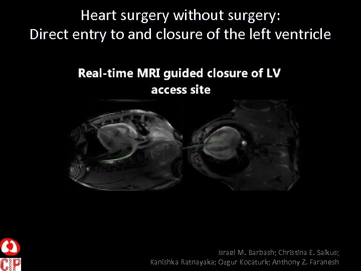 Heart surgery without surgery: Direct entry to and closure of the left ventricle Israel