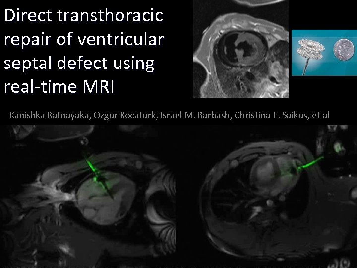 Direct transthoracic repair of ventricular septal defect using real-time MRI Kanishka Ratnayaka, Ozgur Kocaturk,