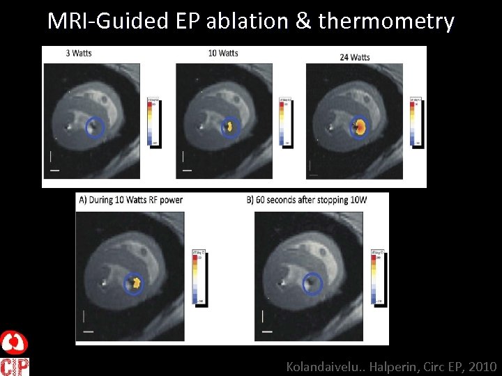 MRI-Guided EP ablation & thermometry Kolandaivelu. . Halperin, Circ EP, 2010 