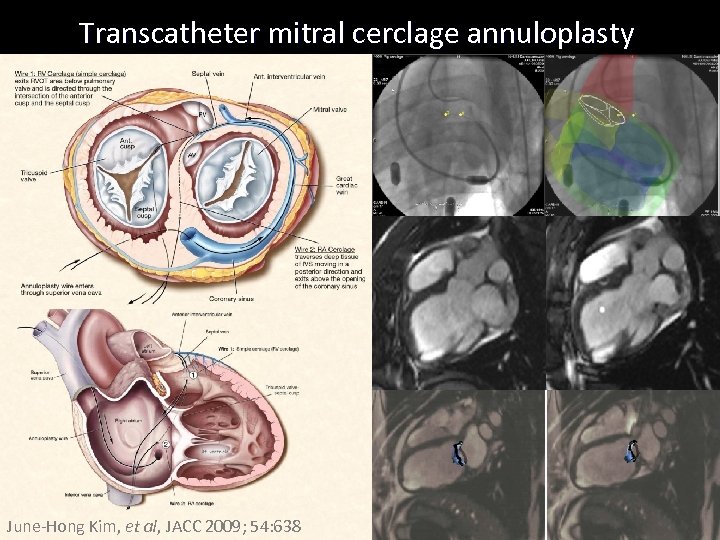 Transcatheter mitral cerclage annuloplasty June-Hong Kim, et al, JACC 2009; 54: 638 