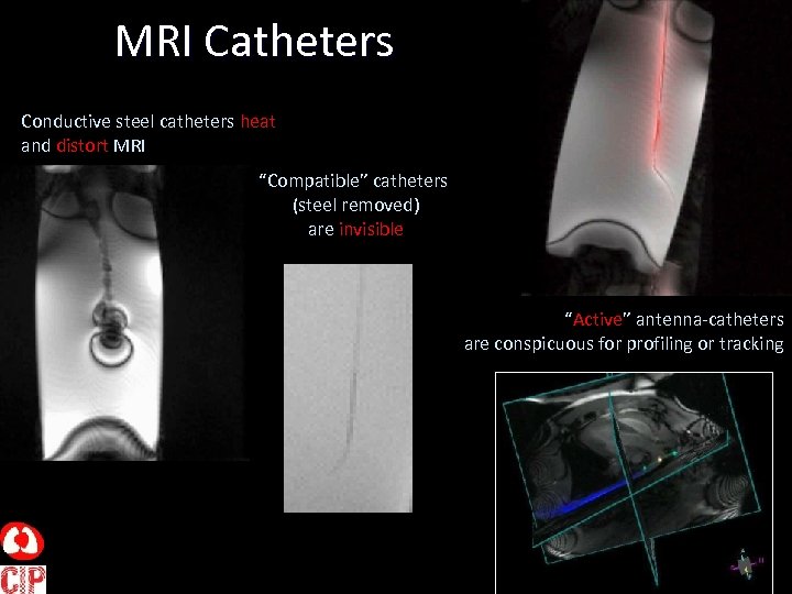 MRI Catheters Conductive steel catheters heat and distort MRI “Compatible” catheters (steel removed) are