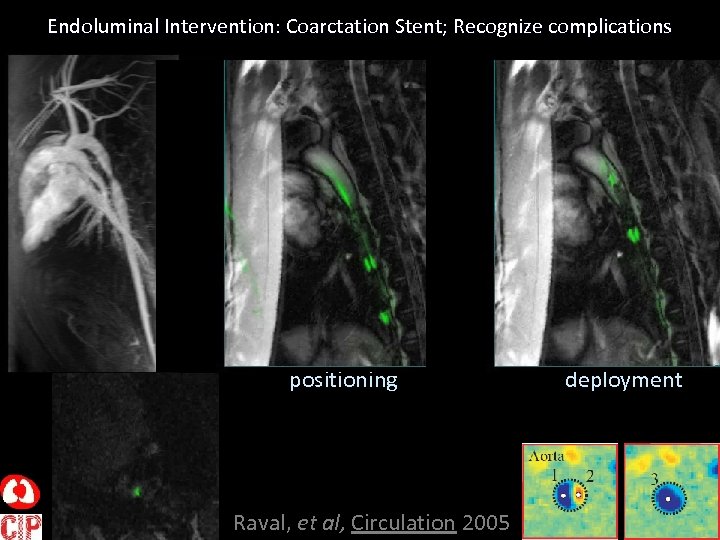 Endoluminal Intervention: Coarctation Stent; Recognize complications positioning Raval, et al, Circulation 2005 deployment 