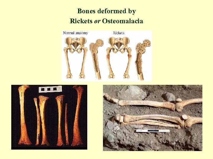 Bones deformed by Rickets or Osteomalacia 