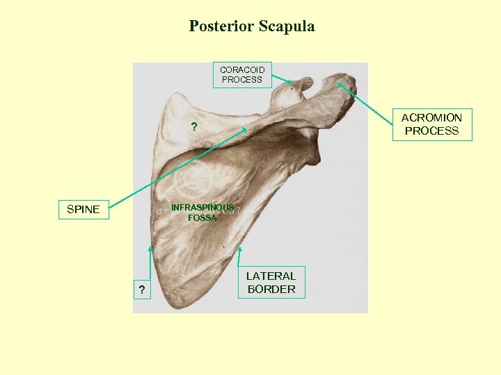 Posterior Scapula CORACOID PROCESS ACROMION PROCESS ? INFRASPINOUS FOSSA SPINE ? LATERAL BORDER 