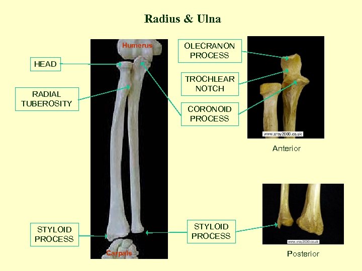 Radius & Ulna Humerus HEAD OLECRANON PROCESS TROCHLEAR NOTCH RADIAL TUBEROSITY CORONOID PROCESS Anterior