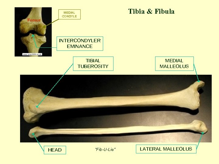 Tibia & Fibula MEDIAL CONDYLE Femur INTERCONDYLER EMINANCE TIBIAL TUBEROSITY HEAD “Fib-U-Lie” MEDIAL MALLEOLUS