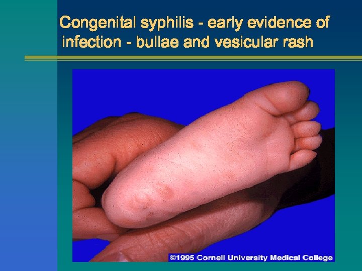 Congenital syphilis - early evidence of infection - bullae and vesicular rash 
