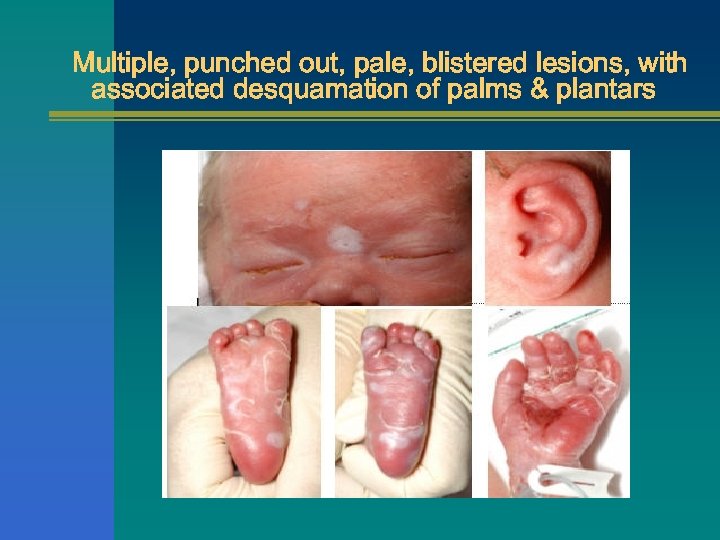 Multiple, punched out, pale, blistered lesions, with associated desquamation of palms & plantars 