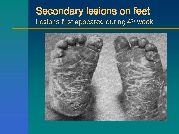 Secondary lesions on feet Lesions first appeared during 4 th week 