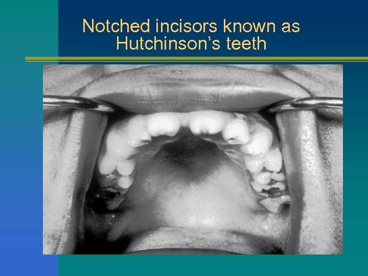 Notched incisors known as Hutchinson’s teeth 