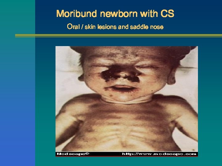 Moribund newborn with CS Oral / skin lesions and saddle nose 