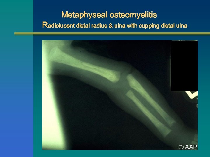 Metaphyseal osteomyelitis Radiolucent distal radius & ulna with cupping distal ulna 