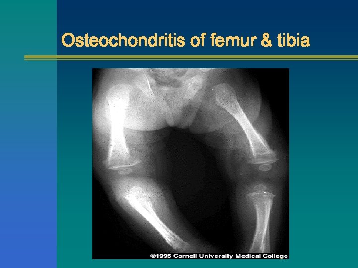 Osteochondritis of femur & tibia 