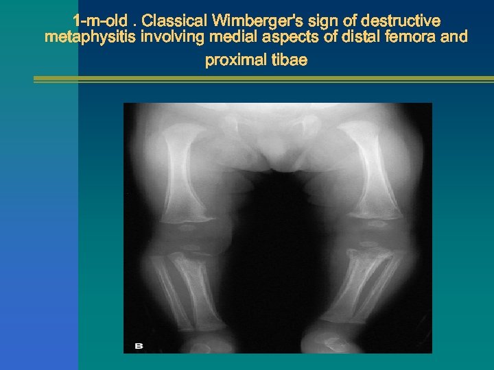 1 -m-old. Classical Wimberger's sign of destructive metaphysitis involving medial aspects of distal femora