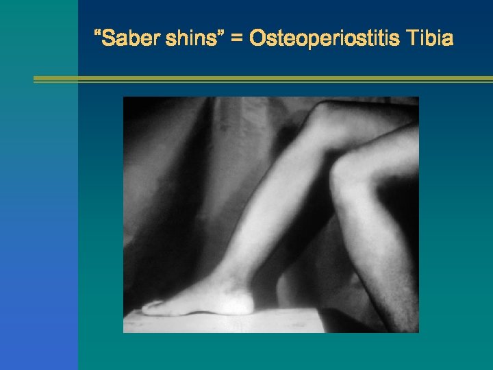 “Saber shins” = Osteoperiostitis Tibia 