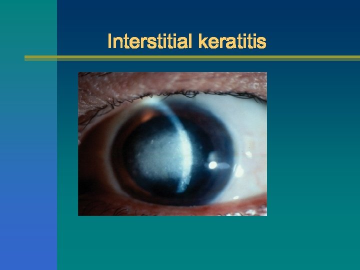 Interstitial keratitis 
