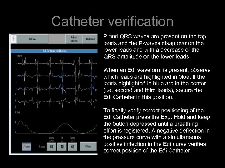 Catheter verification P and QRS waves are present on the top leads and the