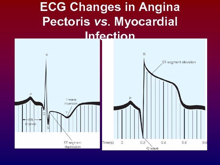 ECG Changes in Angina Pectoris vs. Myocardial Infection 