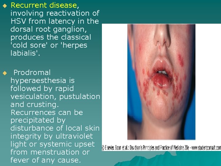 u Recurrent disease, involving reactivation of HSV from latency in the dorsal root ganglion,