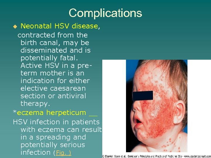 Complications Neonatal HSV disease, contracted from the birth canal, may be disseminated and is
