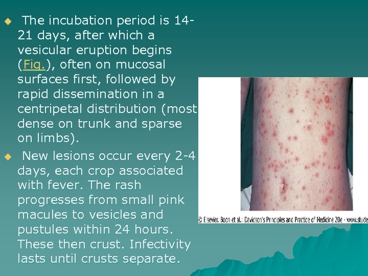 u u The incubation period is 1421 days, after which a vesicular eruption begins