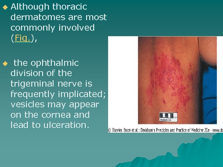 u u Although thoracic dermatomes are most commonly involved (Fig. ), the ophthalmic division