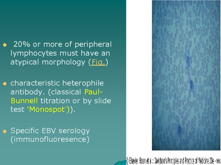 u 20% or more of peripheral lymphocytes must have an atypical morphology (Fig. )