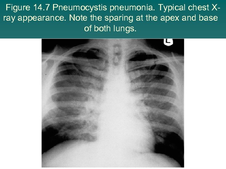 Figure 14. 7 Pneumocystis pneumonia. Typical chest Xray appearance. Note the sparing at the