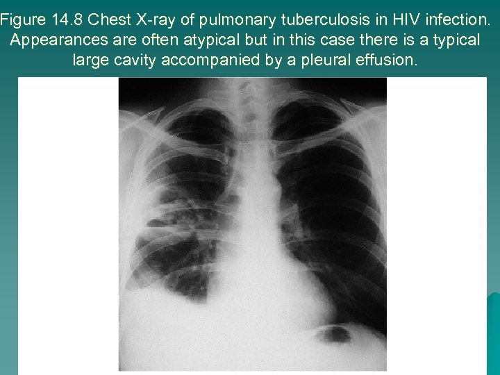 Figure 14. 8 Chest X-ray of pulmonary tuberculosis in HIV infection. Appearances are often