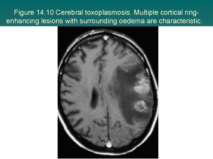 Figure 14. 10 Cerebral toxoplasmosis. Multiple cortical ringenhancing lesions with surrounding oedema are characteristic.
