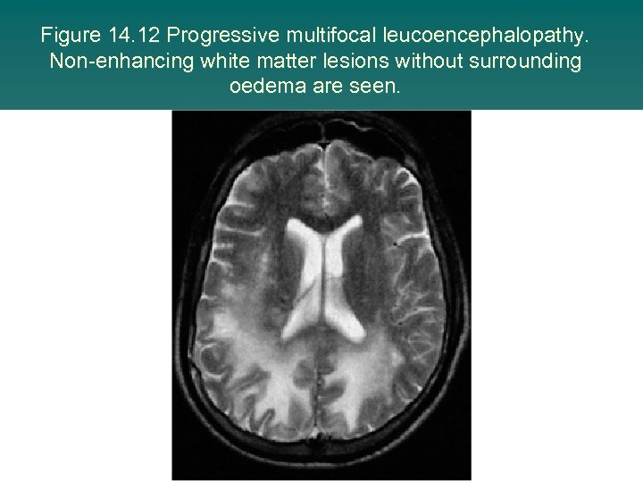 Figure 14. 12 Progressive multifocal leucoencephalopathy. Non-enhancing white matter lesions without surrounding oedema are