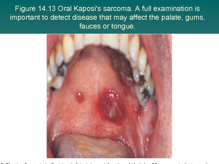 Figure 14. 13 Oral Kaposi's sarcoma. A full examination is important to detect disease