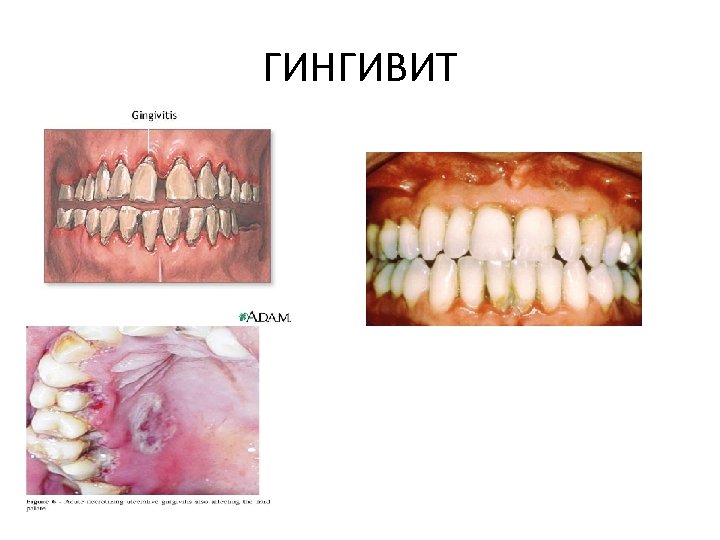 ГИНГИВИТ 