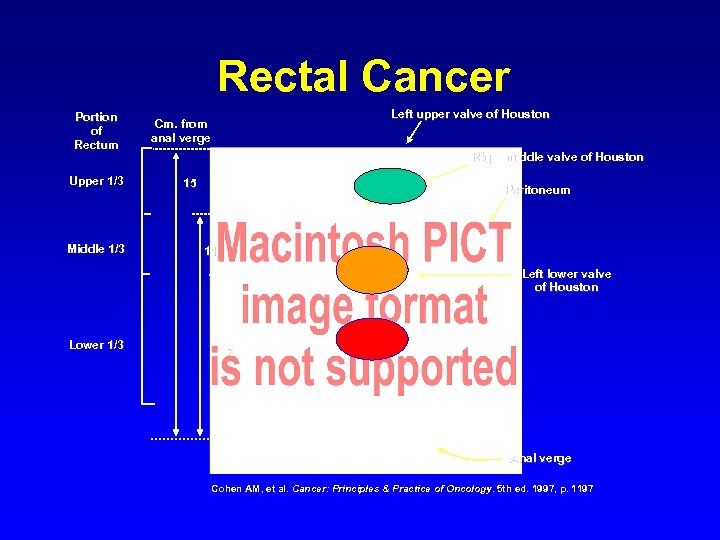 Rectal Cancer Portion of Rectum Upper 1/3 Middle 1/3 Lower 1/3 Left upper valve