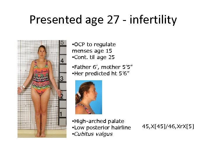 Presented age 27 - infertility • OCP to regulate menses age 15 • Cont.