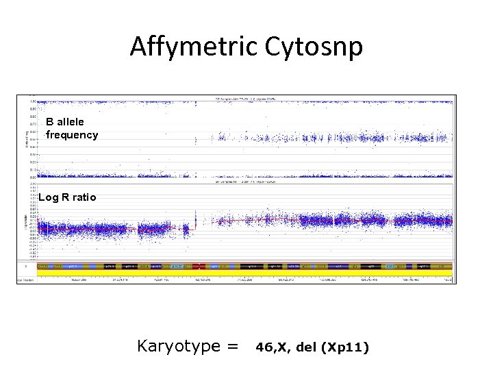 Affymetric Cytosnp B allele frequency Log R ratio Karyotype = 46, X, del (Xp