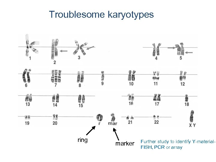 Troublesome karyotypes ring marker Further study to identify Y-material. FISH, PCR or array 