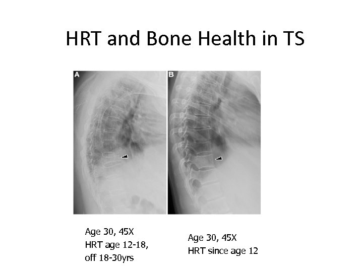 HRT and Bone Health in TS Age 30, 45 X HRT age 12 -18,