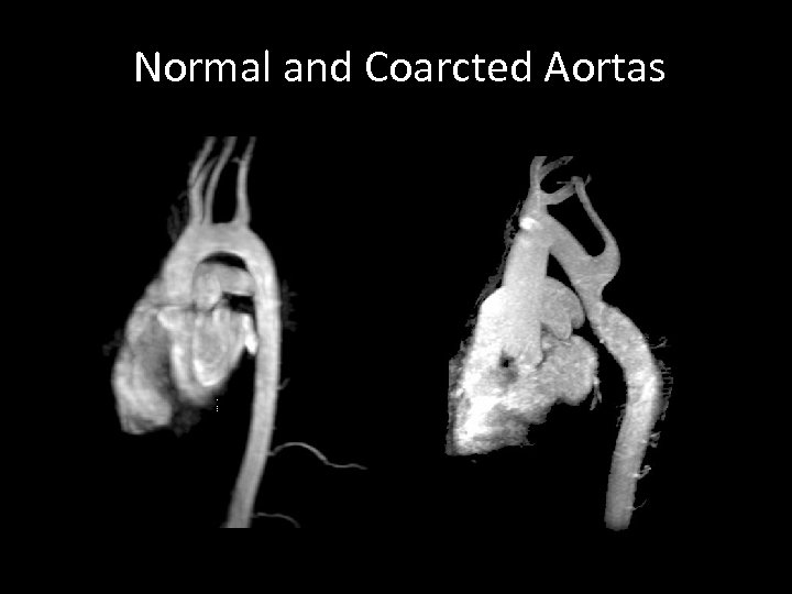 Normal and Coarcted Aortas 