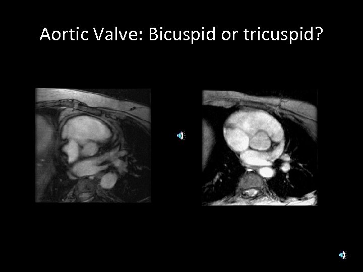 Aortic Valve: Bicuspid or tricuspid? TAV BAV 