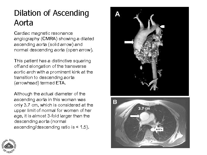 Dilation of Ascending Aorta A Cardiac magnetic resonance angiography (CMRA) showing a dilated ascending