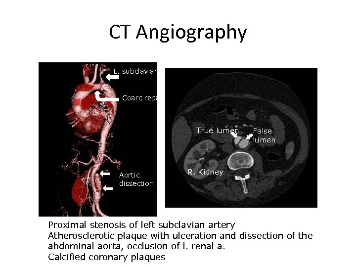 CT Angiography L. subclavian a. Coarc repair True lumen Aortic dissection False lumen R.