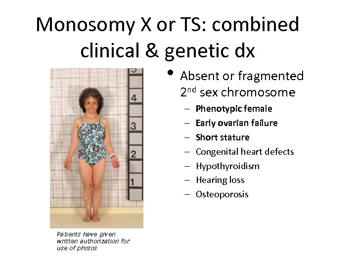 Monosomy X or TS: combined clinical & genetic dx • Absent or fragmented 2