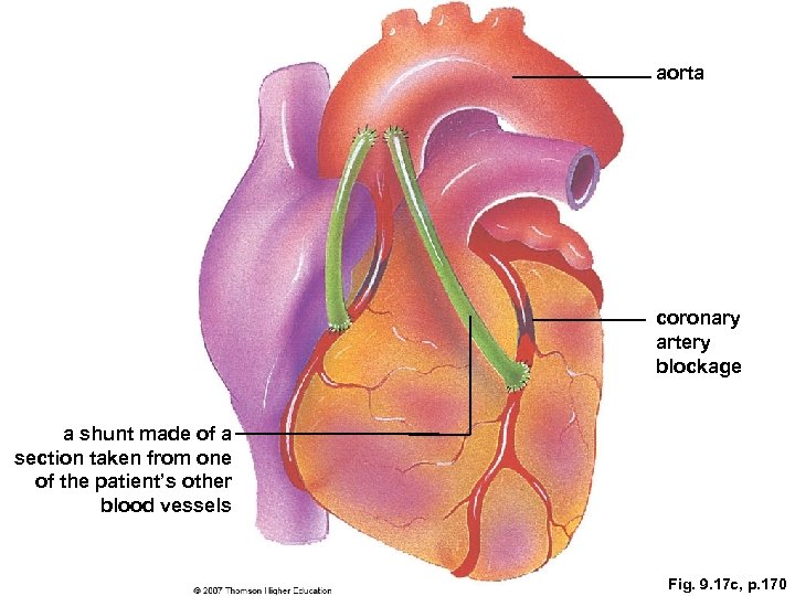 aorta coronary artery blockage a shunt made of a section taken from one of