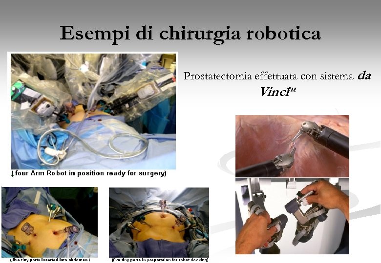 Esempi di chirurgia robotica Prostatectomia effettuata con sistema da Vinci. TM 