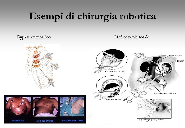 Esempi di chirurgia robotica Bypass coronarico Nefrectomia totale 