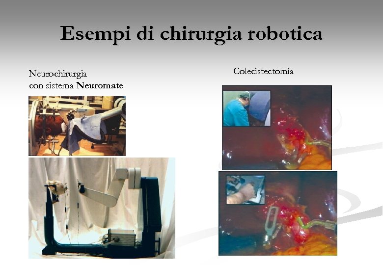 Esempi di chirurgia robotica Neurochirurgia con sistema Neuromate Colecistectomia 