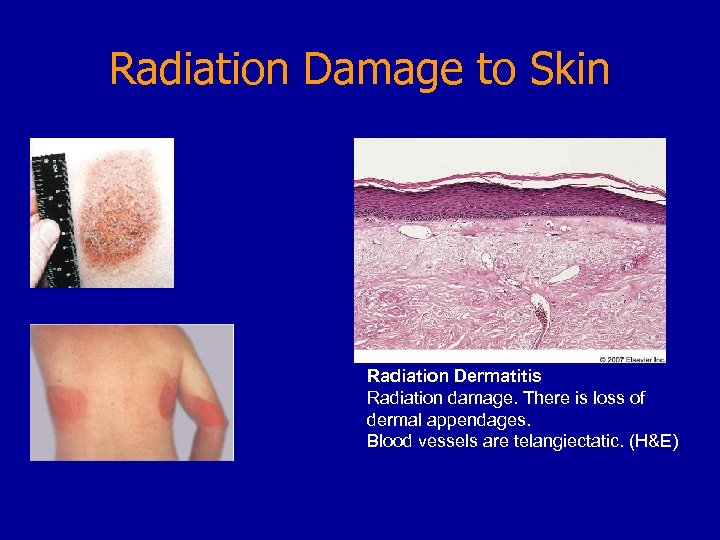 Radiation Damage to Skin Radiation Dermatitis Radiation damage. There is loss of dermal appendages.